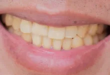 أسباب تغيّر لون الأسنان