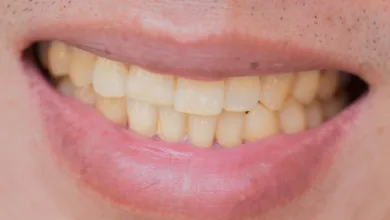 أسباب تغيّر لون الأسنان