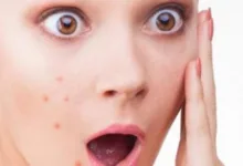 أسباب غير متوقعة لظهور البثور