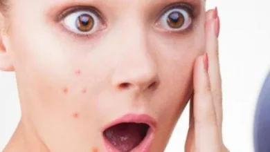 أسباب غير متوقعة لظهور البثور