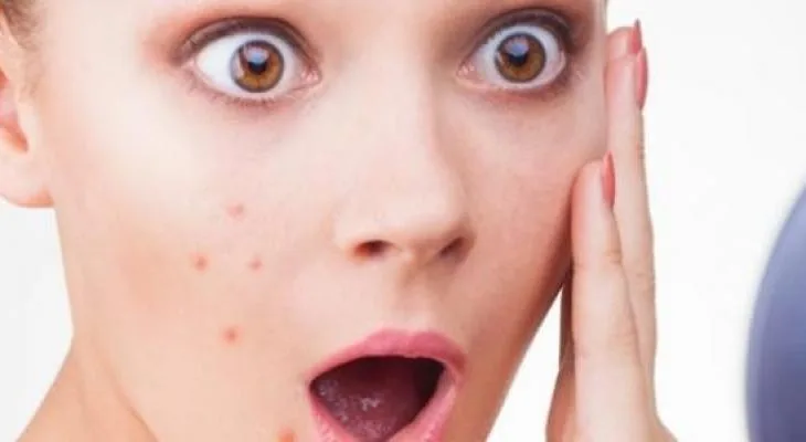 أسباب غير متوقعة لظهور البثور
