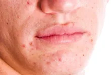 العلاج الصحيح لحب الشباب