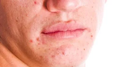 العلاج الصحيح لحب الشباب