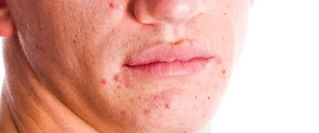 العلاج الصحيح لحب الشباب