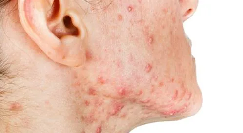 العلاج الصحيح لحب الشباب0