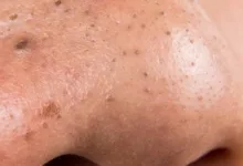 القرفة لمعالجة الرؤوس السوداء