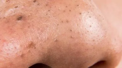 القرفة لمعالجة الرؤوس السوداء