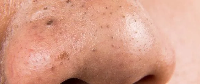 القرفة لمعالجة الرؤوس السوداء