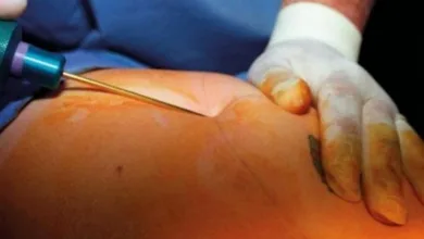 عملية شفط الدهون