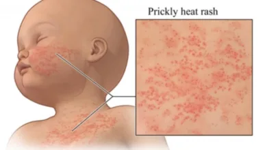 مرض حمو النيل