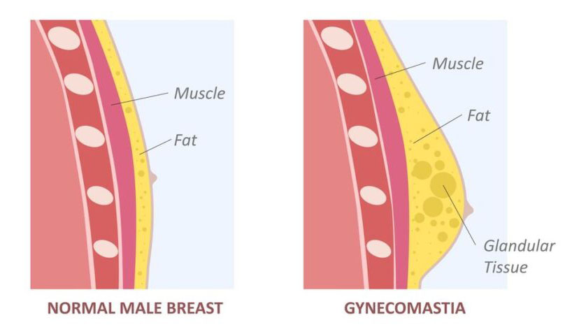 أسباب تضخم الثدي عند الرجال
