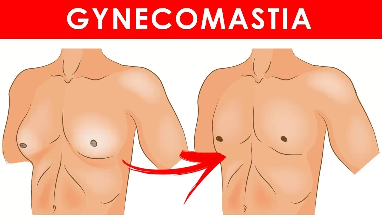 هل يمكن علاج تضخم الثدي عند الرجال طبيعياً؟