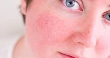 مشاكل البشرة أثناء فصل الصيف