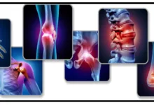 الأماكن الأكثر عرضة للإصابة بخشونة المفاصل