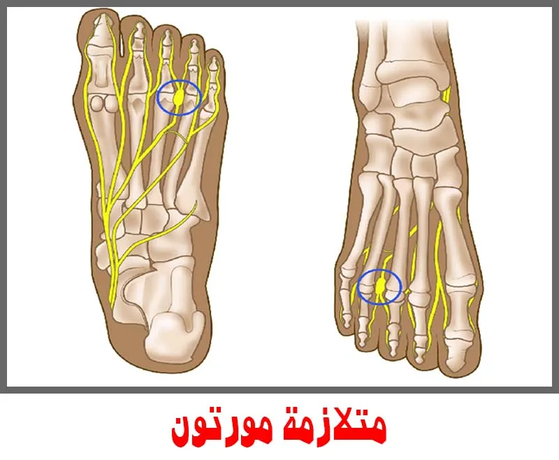 متلازمة مورتون