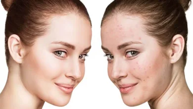 حبوب الوجه تحت السيطرة