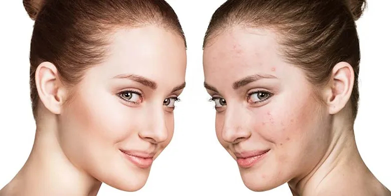 حبوب الوجه تحت السيطرة