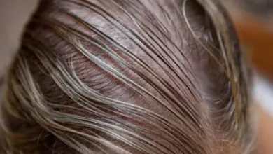 تساقط الشعر عند النساء